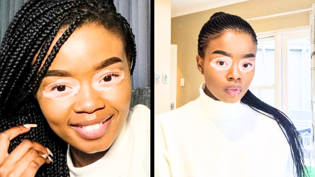 Young woman teased for skin condition doesn't let it bother her